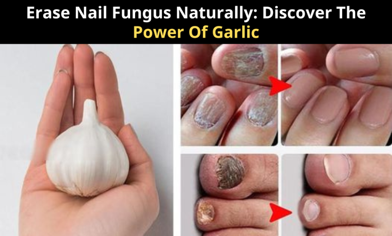 Erase Nail Fungus Naturally: Discover The Power Of Garlic