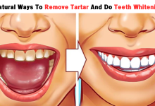 Natural Ways To Remove Tartar And Do Teeth Whitening At Home