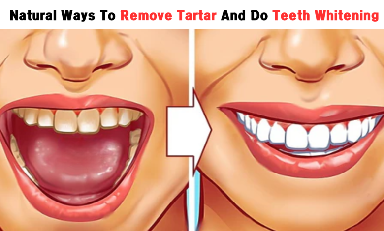 Natural Ways To Remove Tartar And Do Teeth Whitening At Home