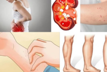 If Your Kidney Is in Danger the Body Will Give You These 8 Signs3