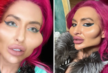 Model With Worlds Biggest Cheeks Shares Unrecognisable Photos From Before Transformation