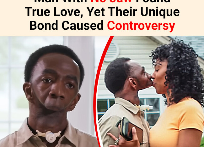 She Cant Kiss Him Man With No Jaw Found True Love Yet Their Unique Bond Caused Controversy