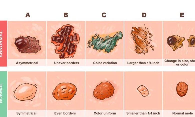 This skin cancer detector guide can save your life e1729567066586